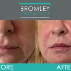 Business 1 image BROMLEY AESTHETICS LTD Dermal Filler Treatment in Orpington Ke