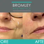 Business 3 image BROMLEY AESTHETICS LTD Dermal Filler Treatment in Orpington Ke