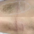 Business 1 image CLEARSKIN Tattoo Removal Service in Newcastle Upon Tyne Ty