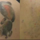 Business 1 image VELVET TATTOO REMOVAL Tattoo Removal in Brighton Ea